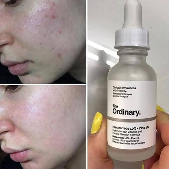 THE ORDINARY - NIACINAMIDE 10% + ZINC 1% - 30ML